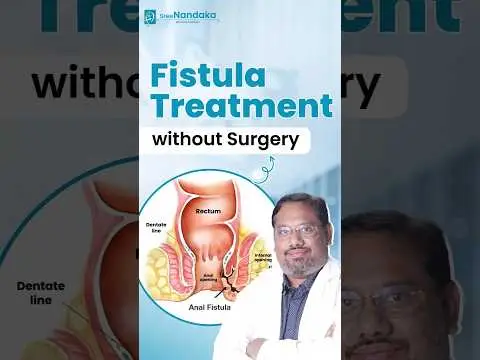 Fistula Treatment without Surgery || HOW TO CURE FISTULA || Dr. Praveen Koduru