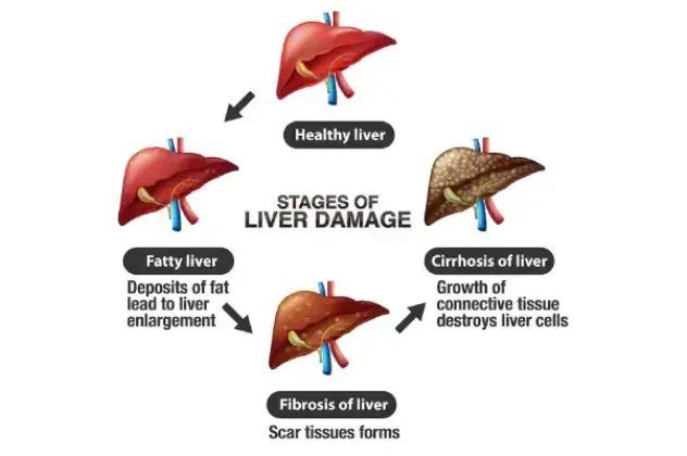 Liver and Pancreas Disorders Treatment in Hyderabad